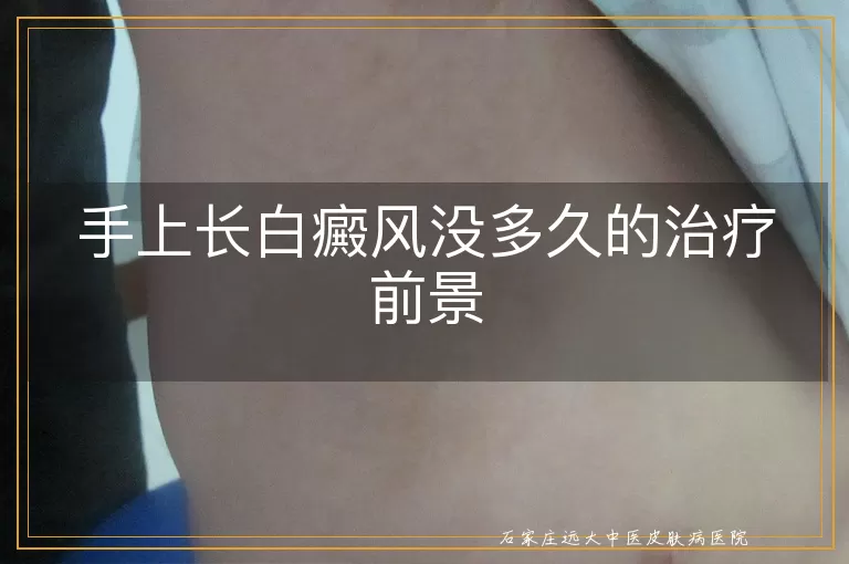 手上长白癜风没多久的治疗前景