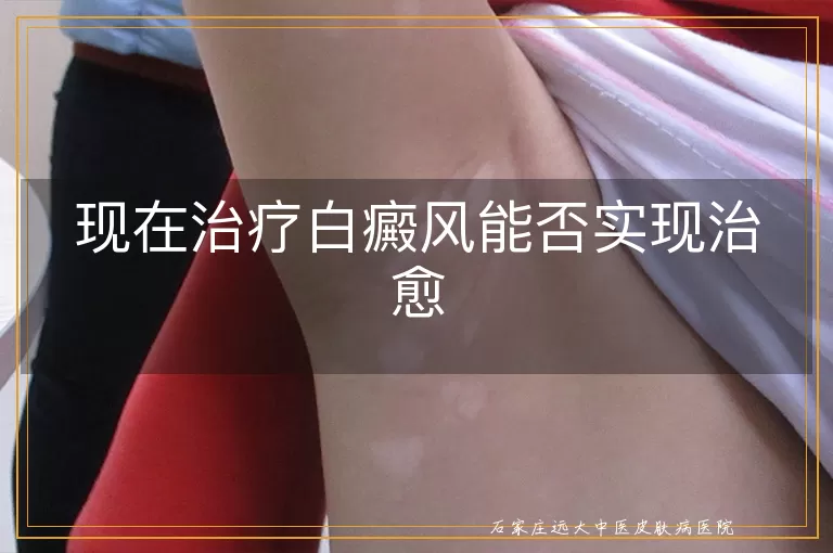 现在治疗白癜风能否实现治愈