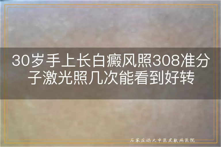 30岁手上长白癜风照308准分子激光照几次能看到好转