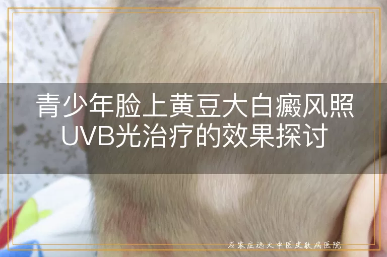 青少年脸上黄豆大白癜风照UVB光治疗的效果探讨