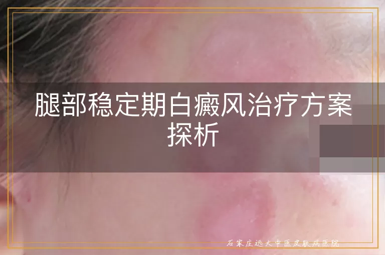 腿部稳定期白癜风治疗方案探析