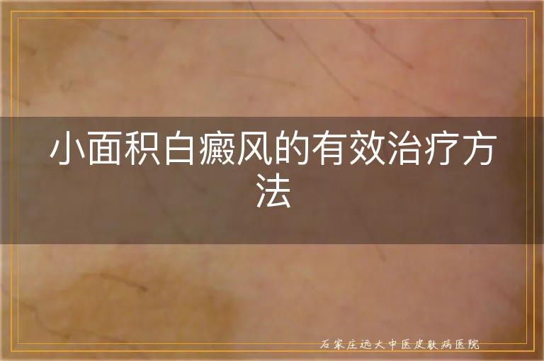 小面积白癜风的有效治疗方法