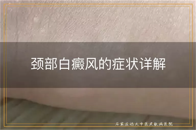 颈部白癜风的症状详解