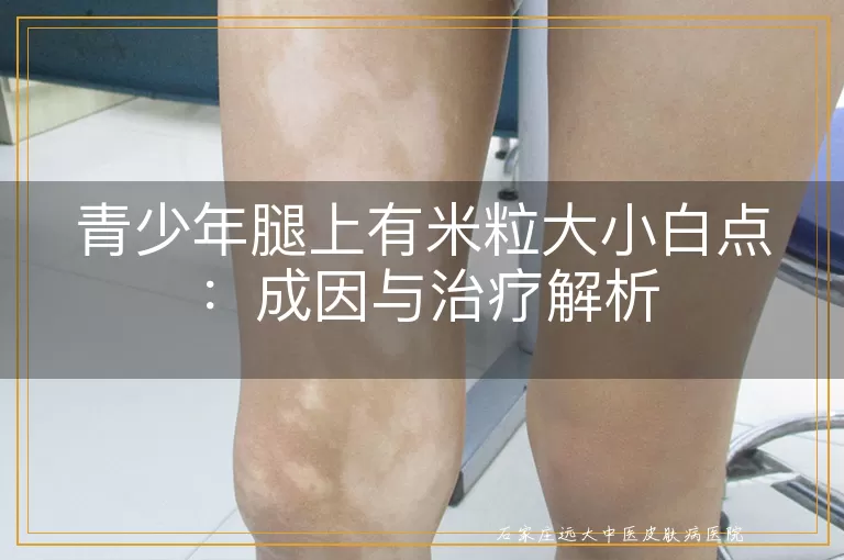 青少年腿上有米粒大小白点：成因与治疗解析