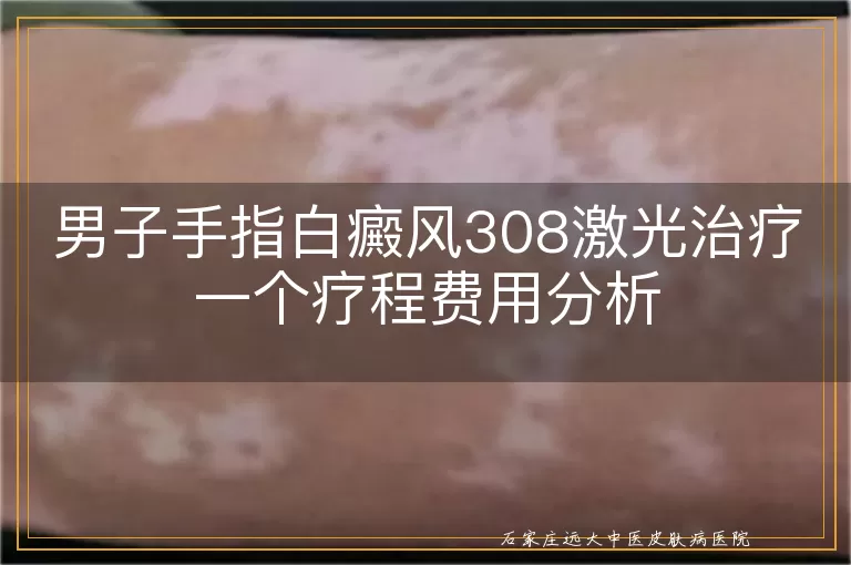 男子手指白癜风308激光治疗一个疗程费用分析