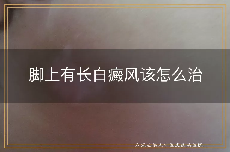 脚上有长白癜风该怎么治