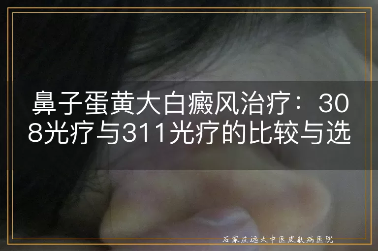 鼻子蛋黄大白癜风治疗：308光疗与311光疗的比较与选择