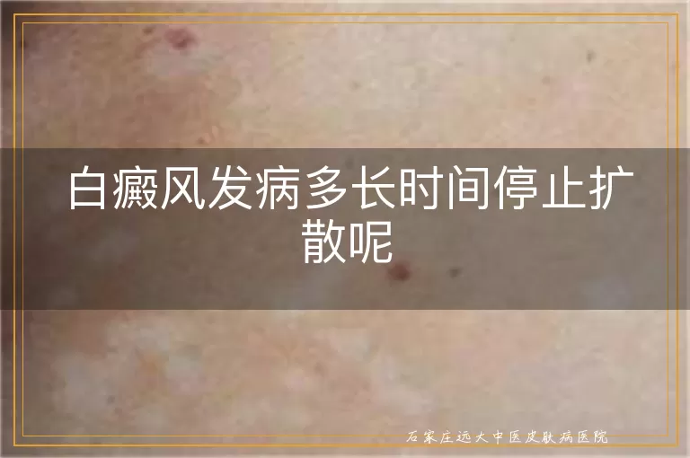 白癜风发病多长时间停止扩散呢