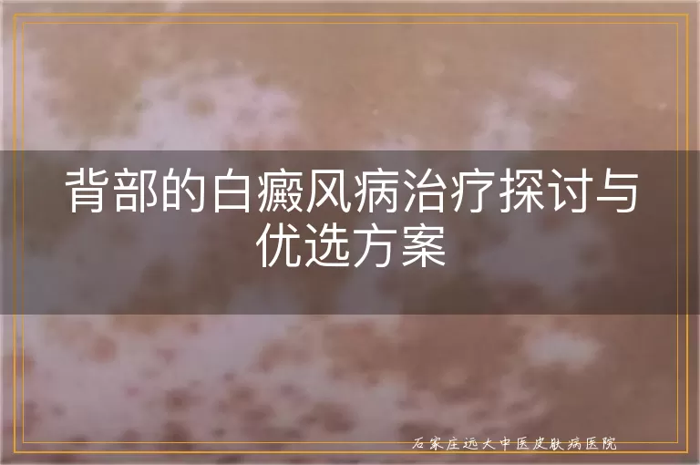 背部的白癜风病治疗探讨与优选方案