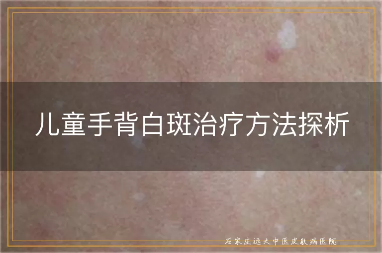 儿童手背白斑治疗方法探析