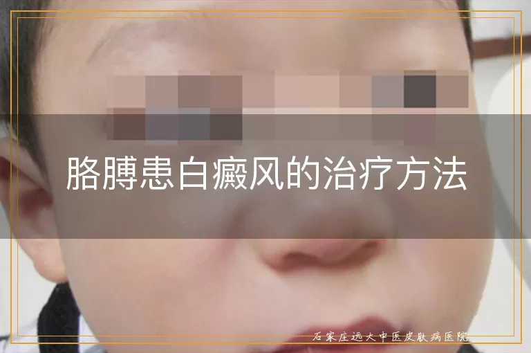 胳膊患白癜风的治疗方法