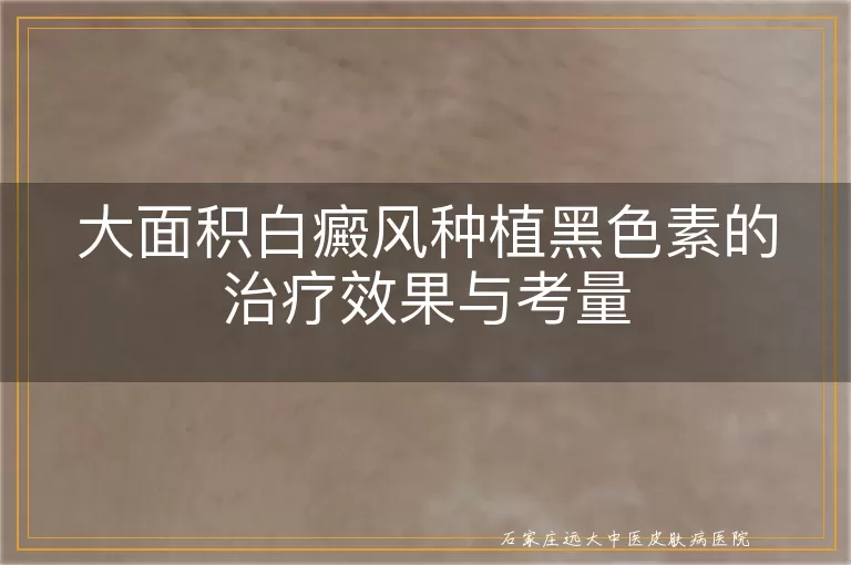 大面积白癜风种植黑色素的治疗效果与考量