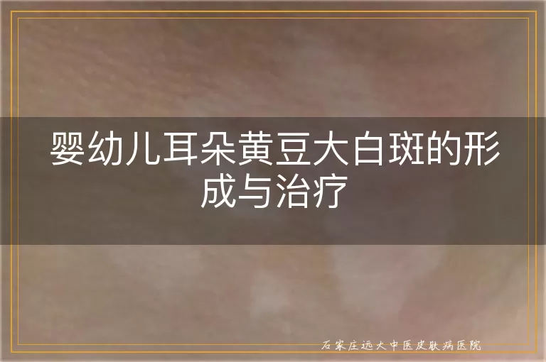 婴幼儿耳朵黄豆大白斑的形成与治疗