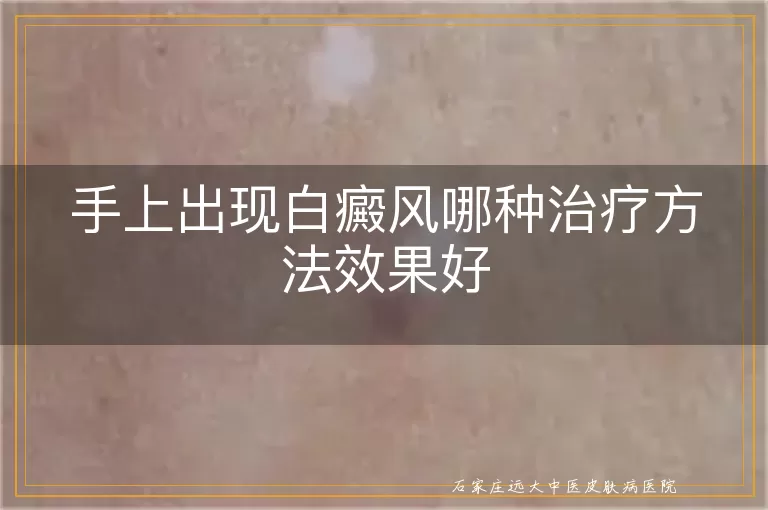 手上出现白癜风哪种治疗方法效果好