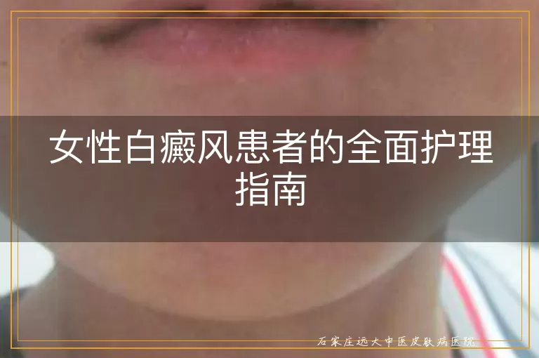 女性白癜风患者的全面护理指南