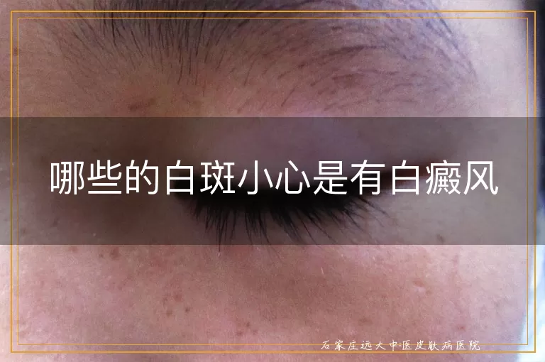 哪些的白斑小心是有白癜风