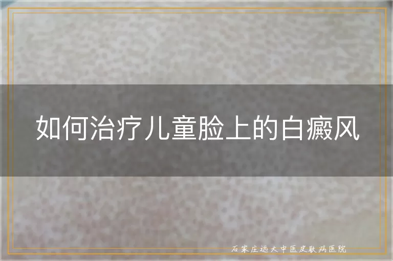 如何治疗儿童脸上的白癜风