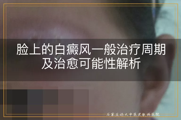 脸上的白癜风一般治疗周期及治愈可能性解析