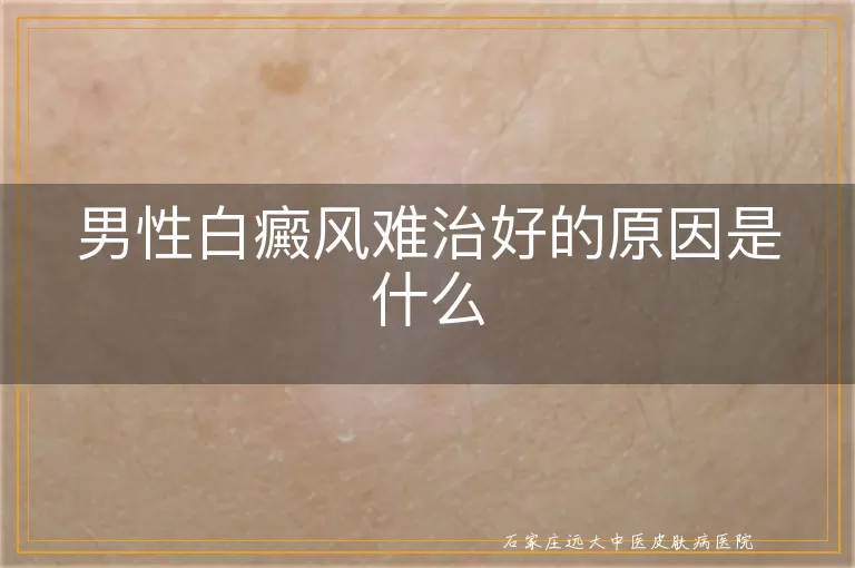 男性白癜风难治好的原因是什么