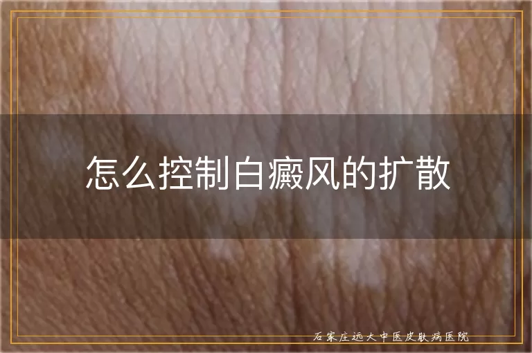 怎么控制白癜风的扩散