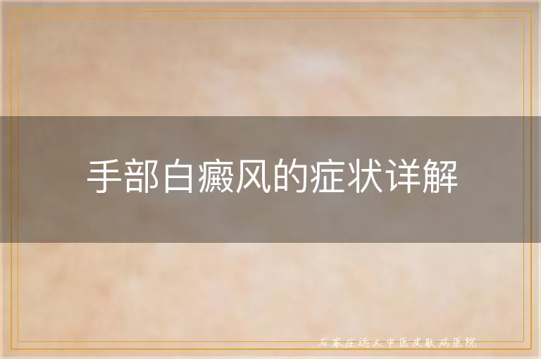 手部白癜风的症状详解