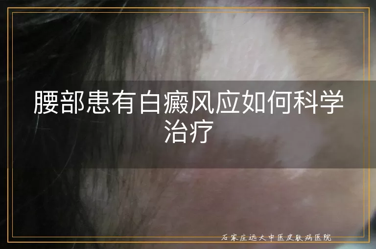 腰部患有白癜风应如何科学治疗