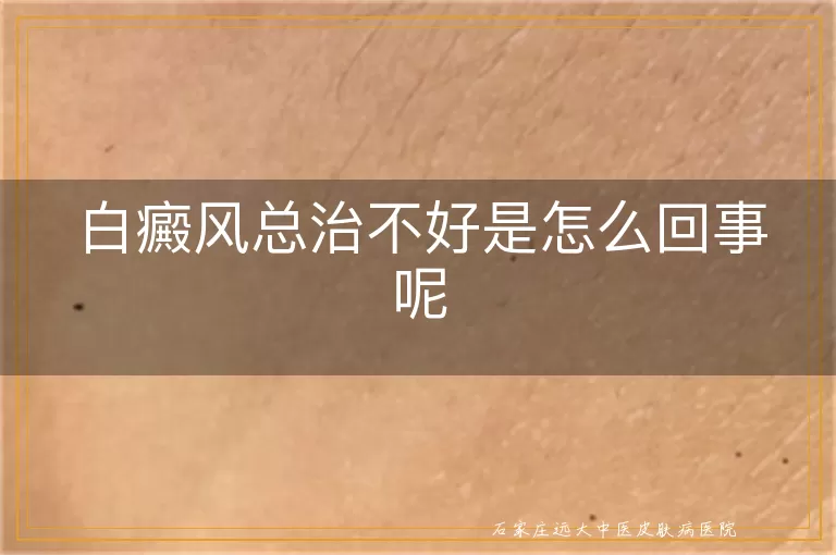白癜风总治不好是怎么回事呢