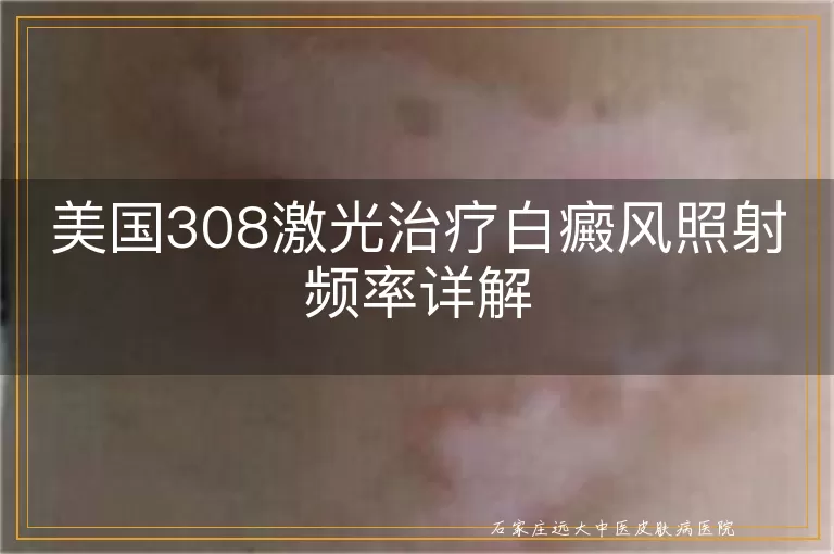 美国308激光治疗白癜风照射频率详解