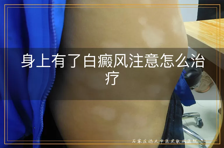 身上有了白癜风注意怎么治疗