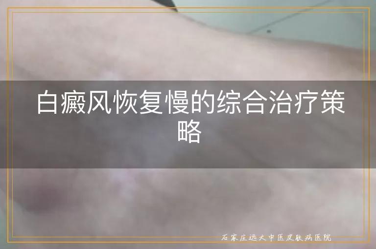 白癜风恢复慢的综合治疗策略