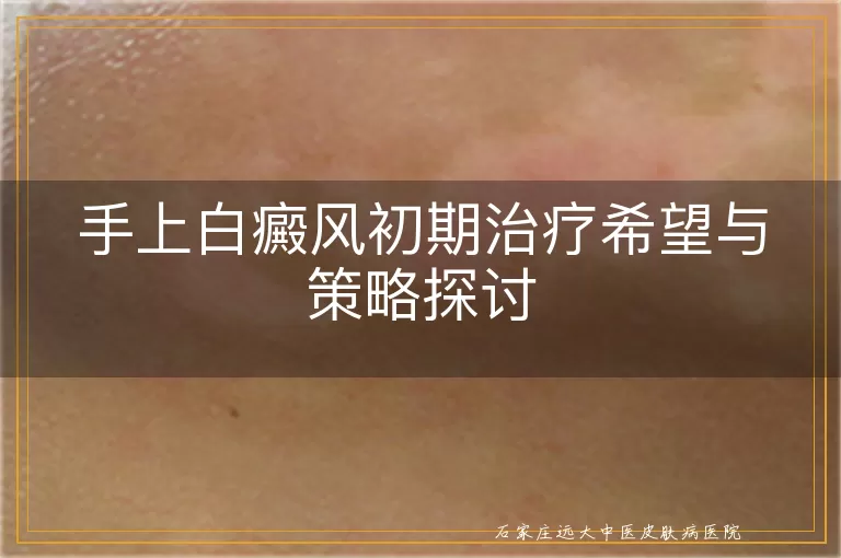 手上白癜风初期治疗希望与策略探讨