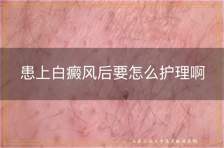 患上白癜风后要怎么护理啊
