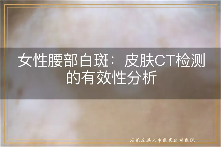 女性腰部白斑：皮肤CT检测的有效性分析
