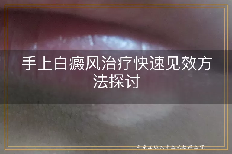 手上白癜风治疗快速见效方法探讨