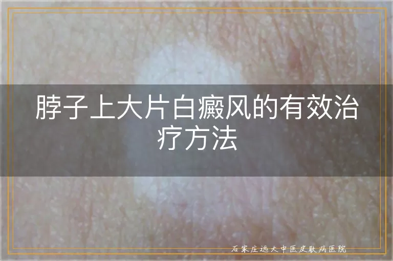脖子上大片白癜风的有效治疗方法