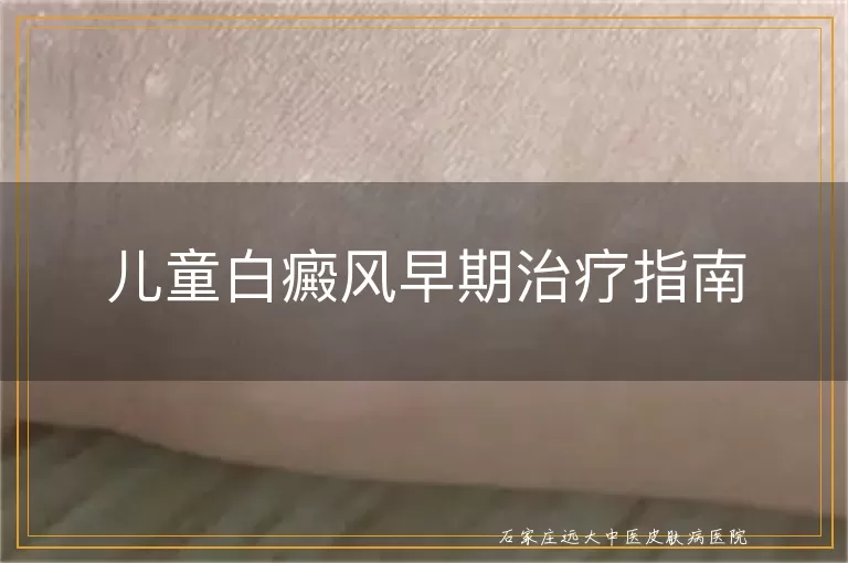 儿童白癜风早期治疗指南