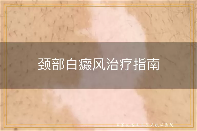 颈部白癜风治疗指南