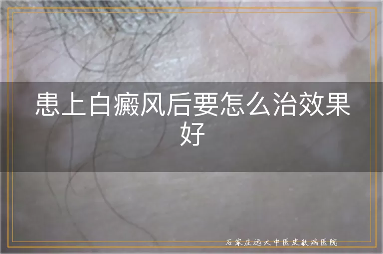 患上白癜风后要怎么治效果好