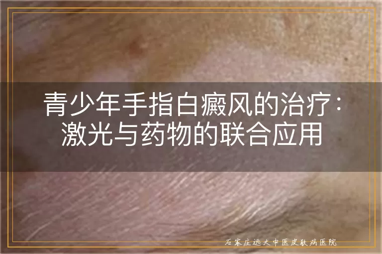 青少年手指白癜风的治疗：激光与药物的联合应用