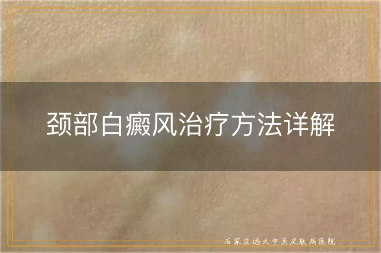 颈部白癜风治疗方法详解