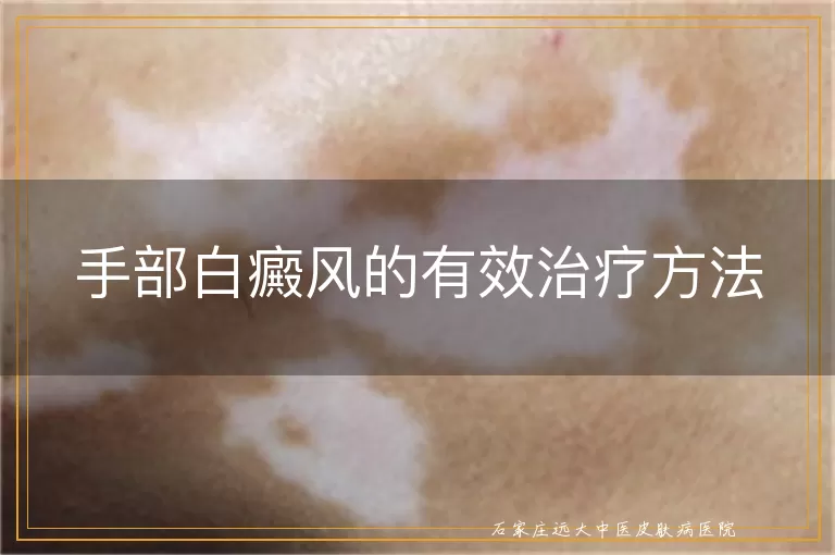 手部白癜风的有效治疗方法