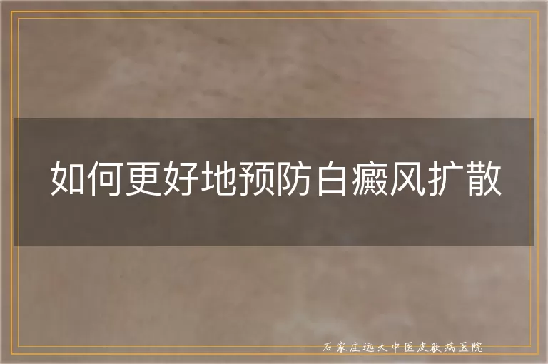 如何更好地预防白癜风扩散