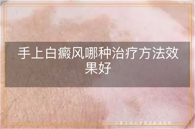 手上白癜风哪种治疗方法效果好