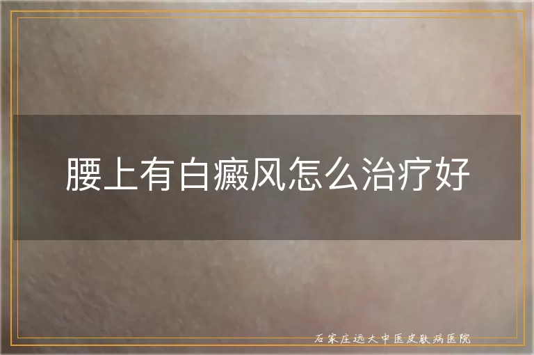 腰上有白癜风怎么治疗好