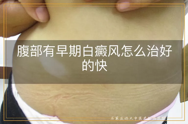 腹部有早期白癜风怎么治好的快