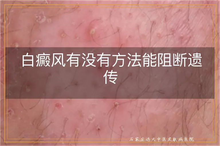白癜风有没有方法能阻断遗传