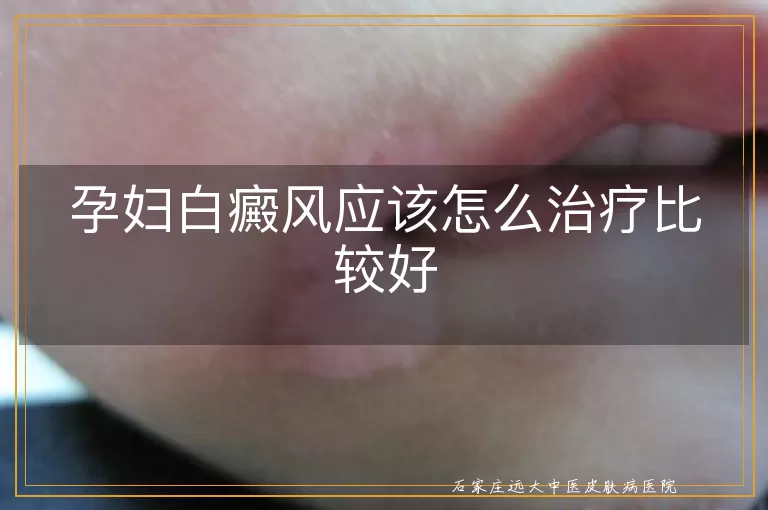 孕妇白癜风应该怎么治疗比较好