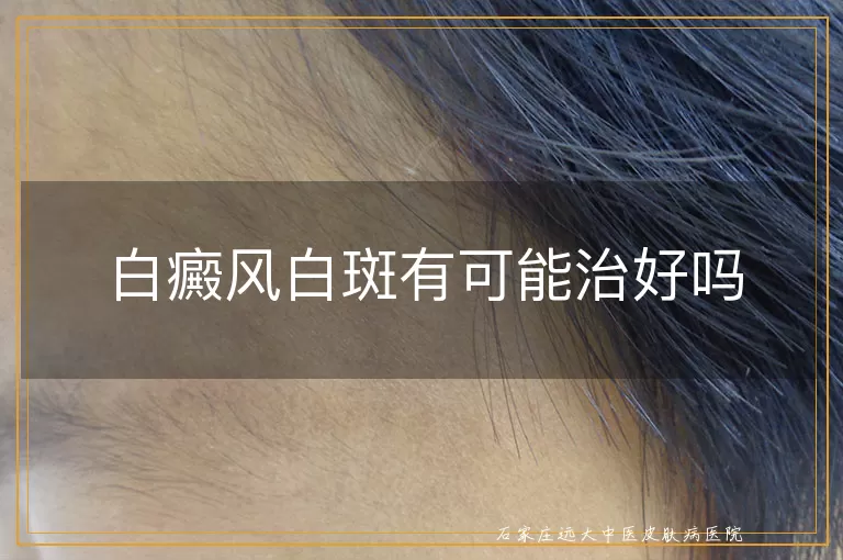 白癜风白斑有可能治好吗