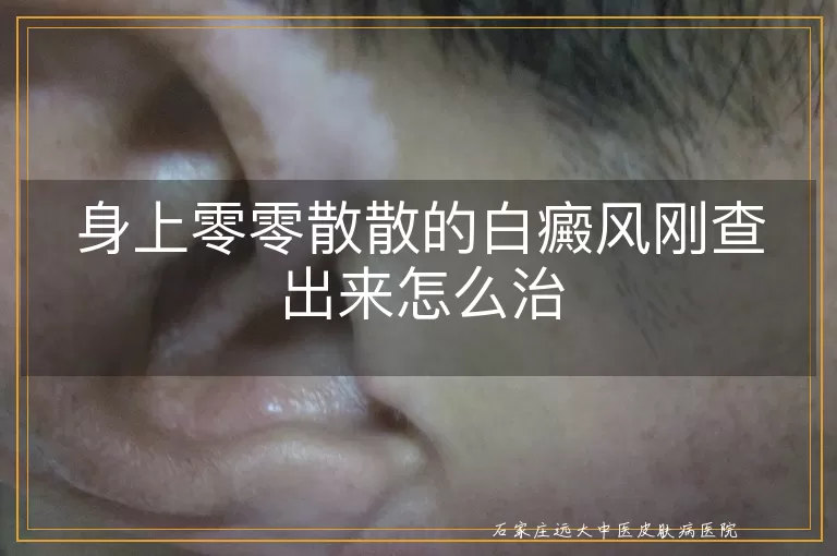 身上零零散散的白癜风刚查出来怎么治