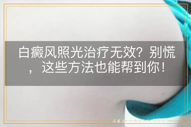 白癜风照光治疗无效？别慌，这些方法也能帮到你！